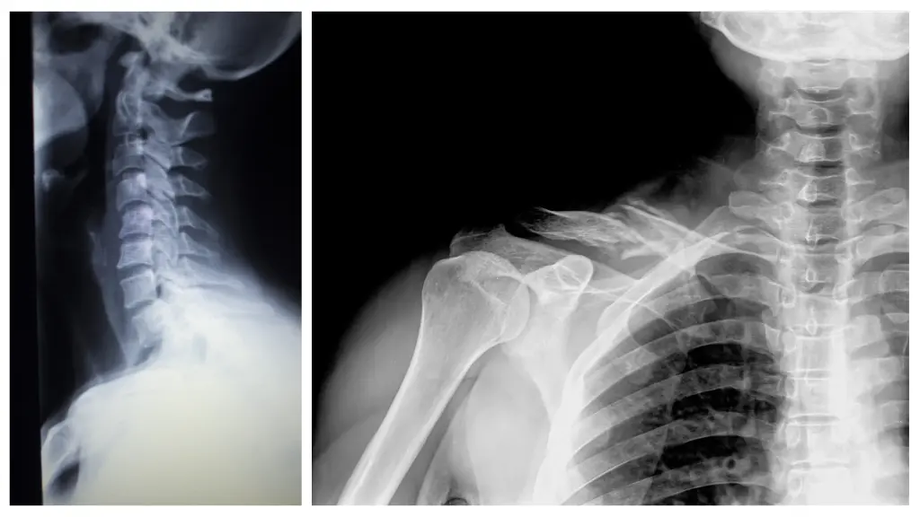 Injuries such as car accidents, if left untreated, can cause long term damage to the neck and spine.